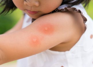 მწერის ნაკბენის დროს ეს მეთოდი ყველაზე ეფექტური საშუალებაა, ინფექციის რისკი ნულია !