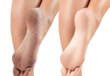 ყველაზე ეფექტური საშუალება, თუ როგორ გამოვაჯანმრთელოთ გამომშრალი და დამსკდარი ქუსლები