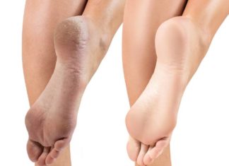 ყველაზე ეფექტური საშუალება, თუ როგორ გამოვაჯანმრთელოთ გამომშრალი და დამსკდარი ქუსლები