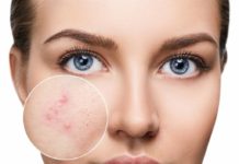 როგორ მოვიცილოთ ფერიმჭამელები? ადგილობრივი მეთოდი, რომელიც ძალიან შედეგიანია!