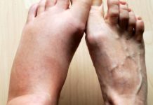 ყველაზე ძლიერი ბუნებრივი საშუალებაა ფეხების შეშუპების წინააღმდეგ!