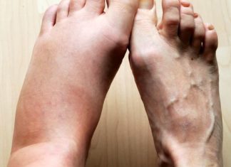 ყველაზე ძლიერი  ბუნებრივი საშუალებაა ფეხების შეშუპების წინააღმდეგ!