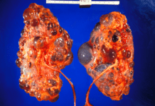 ჩვენს თირკმლებს ყოველდღიურად ვანადგურებთ იმის გამო, რომ ჩვენს ამ 5 ჩვევას ყურადღბას არ ვაქცევთ