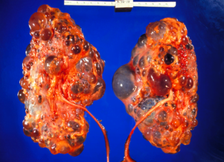 ჩვენს თირკმლებს ყოველდღიურად ვანადგურებთ იმის გამო, რომ ჩვენს ამ 5 ჩვევას ყურადღბას არ ვაქცევთ