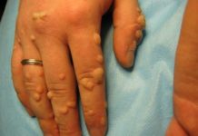 როგორ გავიქროთ მეჭეჭები სახლის პირობებში ზუსტად ერთ კვირაში