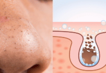 ეს მეთოდი დაგეხმარებათ მარტივად მოიშოროთ შავი წერტილები სახიდან