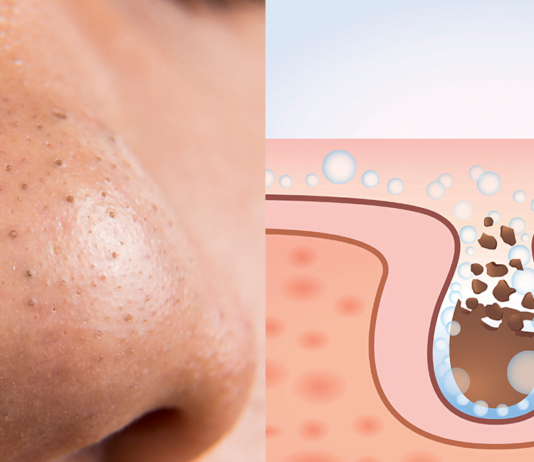 ეს მეთოდი დაგეხმარებათ მარტივად მოიშოროთ შავი წერტილები სახიდან