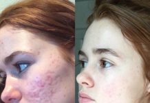 4 პროდუქტი, რომელიც დაგეხმარებათ აკნესგან დატოვებული ლაქებისა და ნაიარევის მოშორებაში