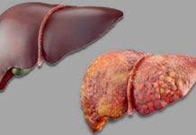 ნიშნები, რომლითაც ჩვენი ორგანიზმი გვანიშნებს ჩვენი ღვიძლის დაბინძურების შესახებ