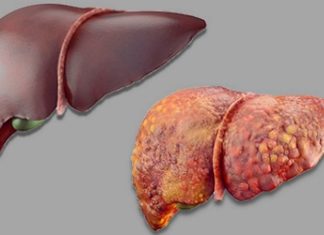 ნიშნები, რომლითაც ჩვენი ორგანიზმი გვანიშნებს ჩვენი ღვიძლის დაბინძურების შესახებ