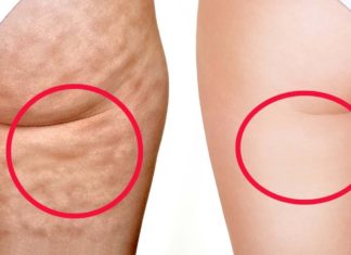 ეს მეთოდი დაგეხმარებათ სახლის პირობებში ცელულიტის დამარცხებაში