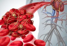 რა იწვევს თრომბის წარმოქმნას და როგორ მოვიქცეთ, რომ არასდროს შეგვაწუხოს ამ პრობლემამ