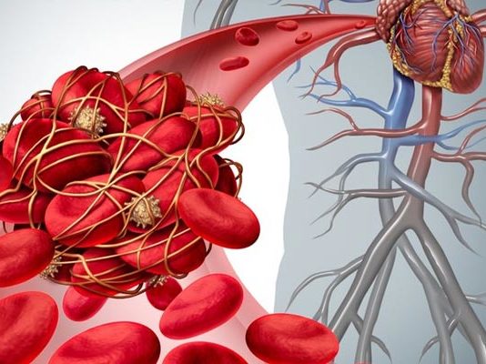 რა იწვევს თრომბის წარმოქმნას და როგორ მოვიქცეთ, რომ არასდროს შეგვაწუხოს ამ პრობლემამ