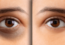 როგორ ვუმკურნალოთ შეშუპებულ უპებს თვალებზე