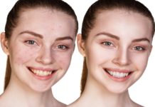 4 უმარტივესი სახის ნიღაბი, რომელიც დაგეხმარებათ გამონაყარის დამარცხებაში