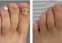 ეს პროდუქტი დაგეხმარებათ ფეხის ფრჩხილის სოკოს უმკურნალოთ მარტივად… ნამდვილად ეფექტურია! ცადეთ!