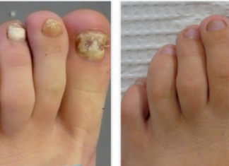 ეს პროდუქტი დაგეხმარებათ ფეხის ფრჩხილის სოკოს უმკურნალოთ მარტივად… ნამდვილად ეფექტურია! ცადეთ!