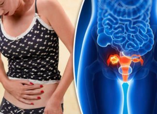 საკვერცხის კიბოს 6 სიმპტომი, რომლიც დაგეხმარებათ თავიდან აირიდოთ დაავადების განვითარება ან სიმსივნის რისკი