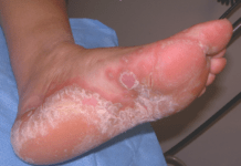 როგორ შეიძლება გაგიჩნდეთ ფეხის სოკო და როგორ ვუმკურნალოთ