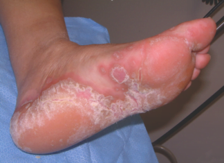 როგორ შეიძლება გაგიჩნდეთ ფეხის სოკო და როგორ ვუმკურნალოთ