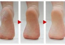 სამუდამოდ დაემშვიდობეთ გამომშრალ და დახეთქილ ქუსლებს! საოცარი შედეგი აქვს ამ ნიღაბს