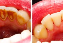 თუ კბილის ქვა და ნადები გაწუხებთ, ჩვენ დაგეხმარებით სახლისი პირობებში მოიცილოთ მარტივად