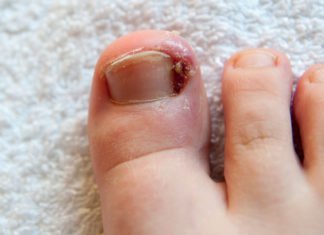 რა იწვევს და როგორ მოვუაროთ ჩაზრდილ ფრჩხილს