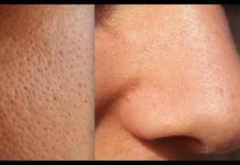 7 ყველაზე ეფექტური და სასარგებლო რეცეპტი გაფართოებული ფორების წინააღმდეგ