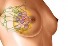 რას უნდა მივაქციოთ ყურადღება, რომ ძუძუს კიბოსგან დავიცვათ თავი