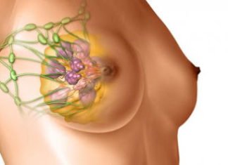 რას უნდა მივაქციოთ ყურადღება, რომ ძუძუს კიბოსგან დავიცვათ თავი