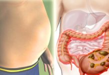 ბაქტერია, რომელიც იწვევს მუცლის შებერილობას! გათავისუფლდით მისგან ამ ნაყენის საშუალებით