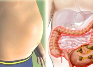 ბაქტერია, რომელიც იწვევს მუცლის შებერილობას! გათავისუფლდით მისგან ამ ნაყენის საშუალებით