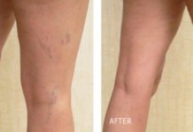 მარტივი საშუალება მარილების და სხეულზე კაპილარების მოსაშორებლად! გაოცდებით შედეგით!