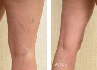 მარტივი საშუალება მარილების და სხეულზე კაპილარების მოსაშორებლად! გაოცდებით შედეგით!