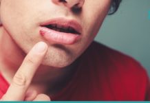 თურმე ჰერპესის მოშორება 1 დღეშია შესაძლებელი – ეს ხერხი ახლავე უნდა ისწავლოთ