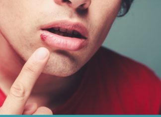 თურმე ჰერპესის მოშორება 1 დღეშია შესაძლებელი – ეს ხერხი ახლავე უნდა ისწავლოთ