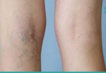 როგორ გავაქროთ კანზე შესამჩნევი ვენები? მარტივი და ეფექტური გამოსავალია