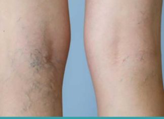 როგორ გავაქროთ კანზე შესამჩნევი ვენები? მარტივი და ეფექტური გამოსავალია