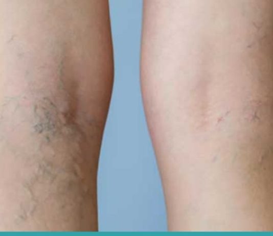 როგორ გავაქროთ კანზე შესამჩნევი ვენები? მარტივი და ეფექტური გამოსავალია