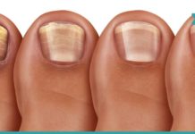 როგორ ვებრძოლოთ ფრჩხილის სოკოს? 6 ეფექტური პროდუქტი, რომელიც ამ დაავადებას დაგავიწყებთ