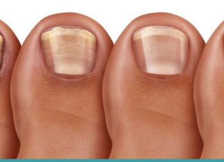 როგორ ვებრძოლოთ ფრჩხილის სოკოს? 6 ეფექტური პროდუქტი, რომელიც ამ დაავადებას დაგავიწყებთ