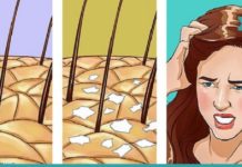 რა არის ქერტლი და როგორ ვუმკურნალოთ მას სახლის პირობებში?