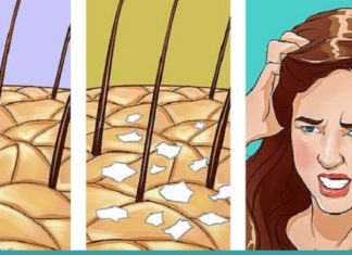 რა არის ქერტლი და როგორ ვუმკურნალოთ მას სახლის პირობებში?