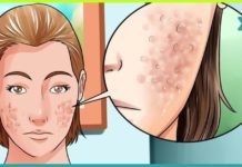 რა იწვევს აკნეს და როგორ ვებრძოლოთ მას?! ეს რეცეპტები დაგეხმარებათ