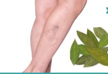 დაფნის ფოთლებით ვენების ვარიკოზისა და სახსრების ტკივილისგან განიკურნებით