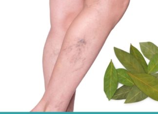 დაფნის ფოთლებით ვენების ვარიკოზისა და სახსრების ტკივილისგან განიკურნებით