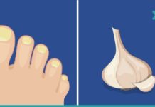 ფრჩხილის სოკო გაწუხებთ? დაემშვიდობეთ მას ამ უნიკალური მეთოდის დახმარებით!