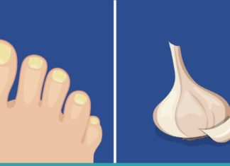 ფრჩხილის სოკო გაწუხებთ? დაემშვიდობეთ მას ამ უნიკალური მეთოდის დახმარებით!