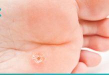 კოჟრების მოშორების მარტივი და ეფექტური ხერხი. ეს ინფორმაცია აუცილებლად გამოგადგებათ