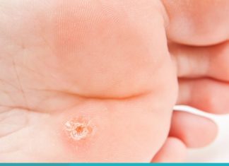 კოჟრების მოშორების მარტივი და ეფექტური ხერხი. ეს ინფორმაცია აუცილებლად გამოგადგებათ